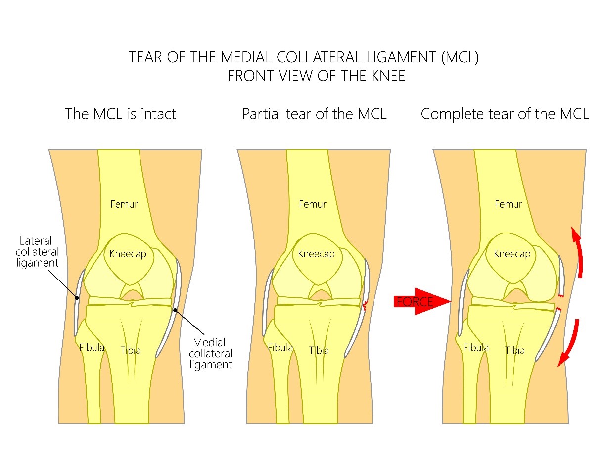 Medal collateral ligament injury