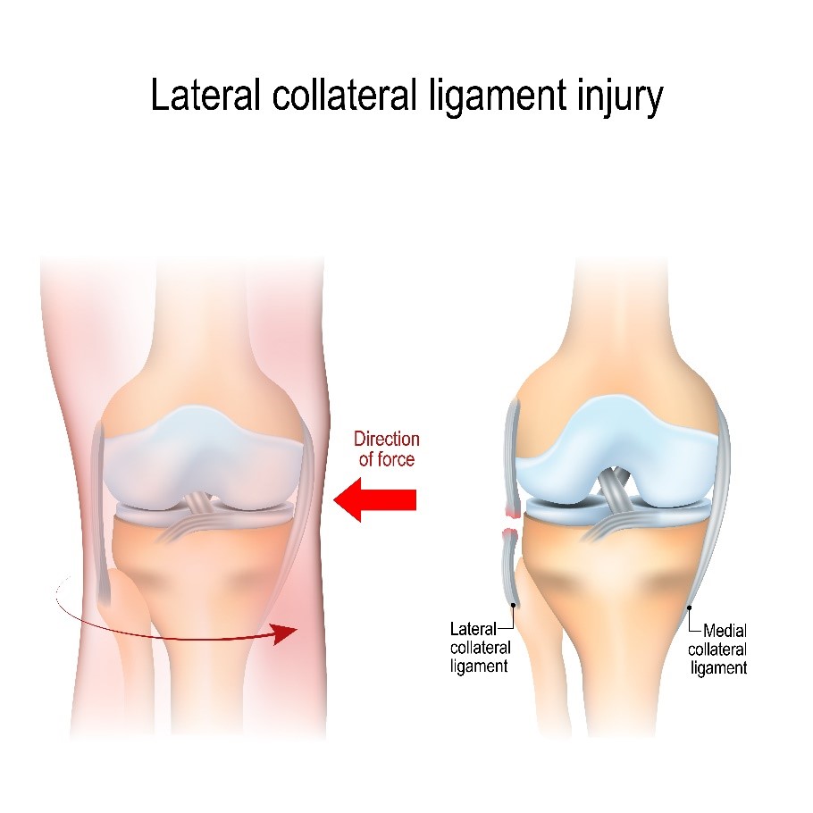collateral ligament injury