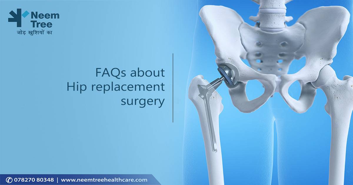 FAQs about Hip replacement surgery