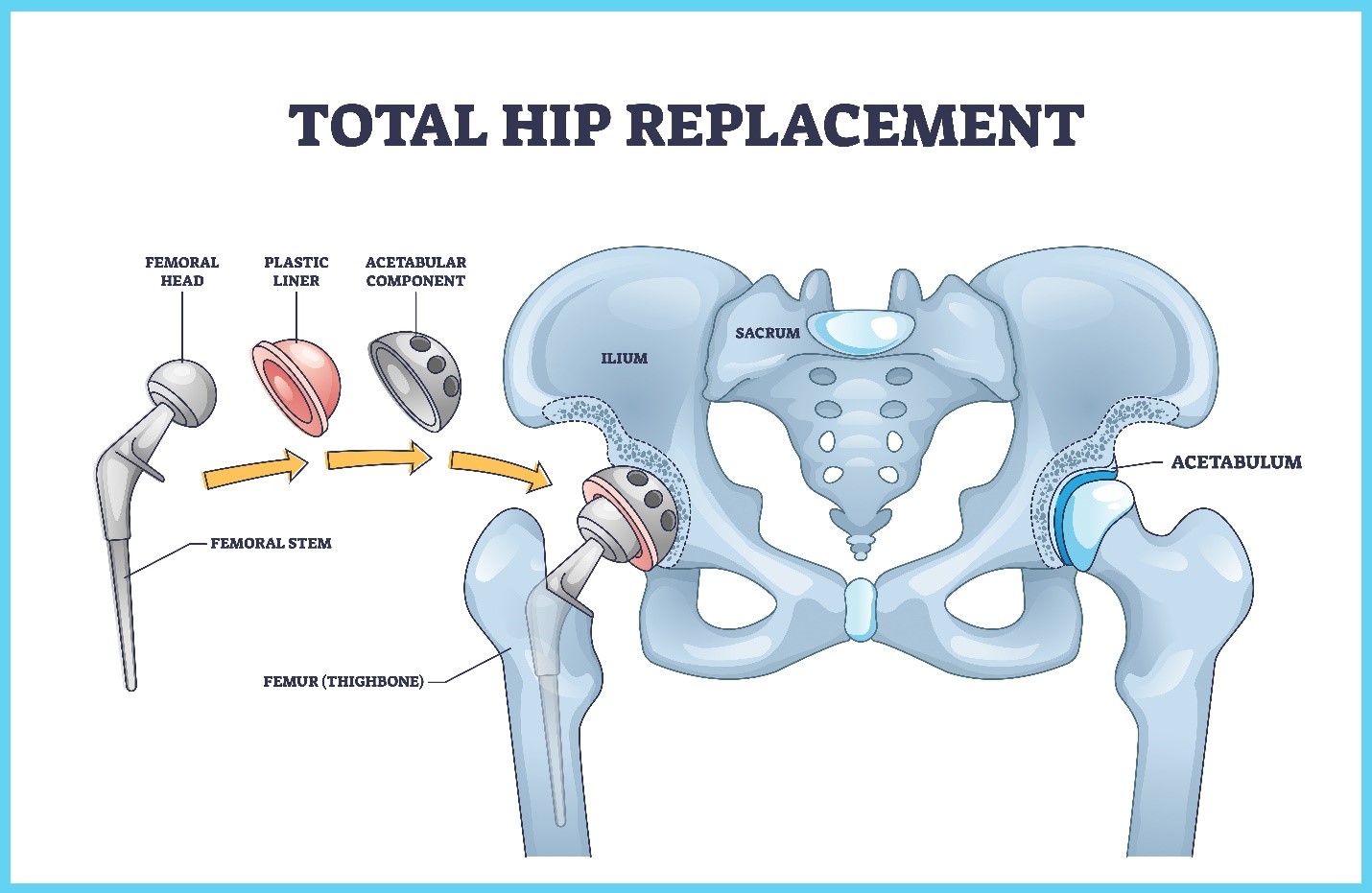 Revision Total Hip Replacement, Richmond VA, Dr Wind